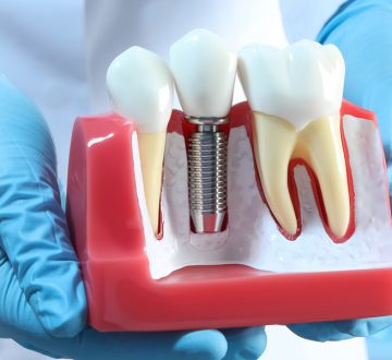 What Are The Benefits Of Dental Implants?