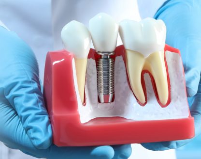 What Are The Benefits Of Dental Implants? 