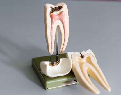 Root-Canal