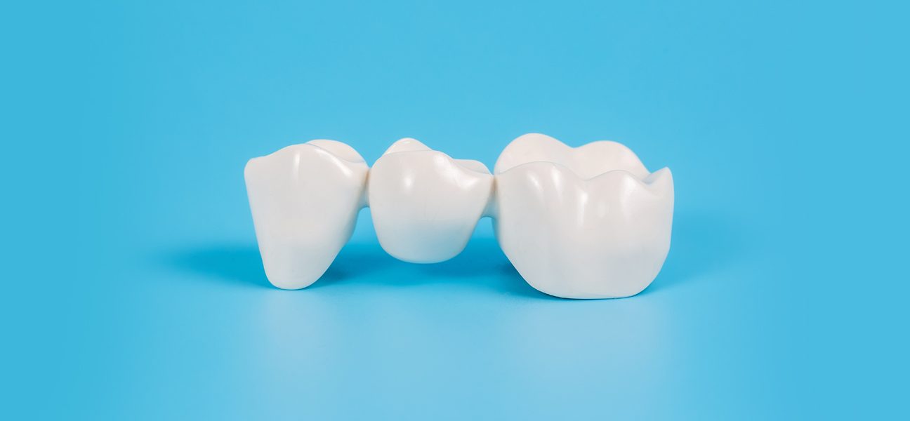 6 Things To Know Before Considering a Dental Bridge