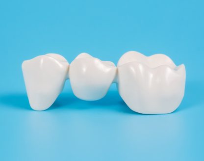 6 Things To Know Before Considering a Dental Bridge