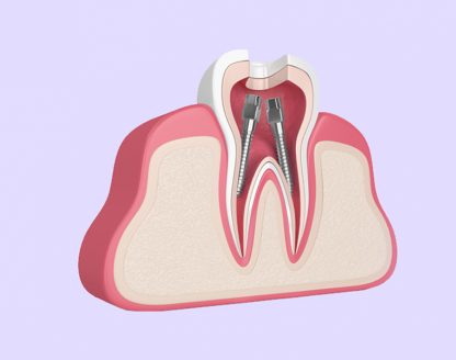 The Importance of Endodontics in Saving Natural Teeth