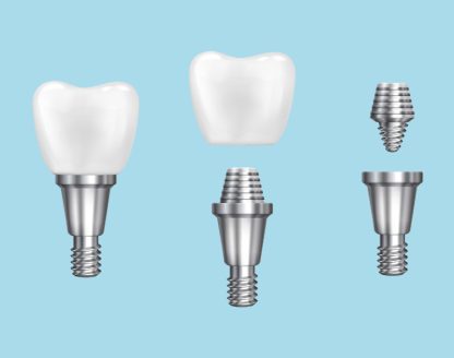 5 Benefits of Dental Implants